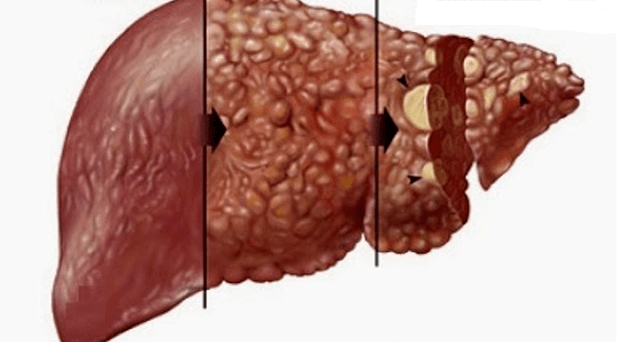 harmful effects of alcohol on the human liver