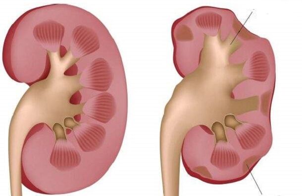 healthy and diseased kidney when drinking alcohol